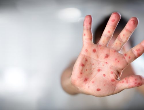 Hand Foot and Mouth Disease