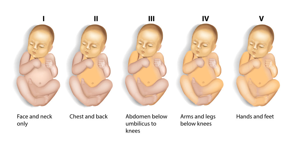 Jaundice Stages