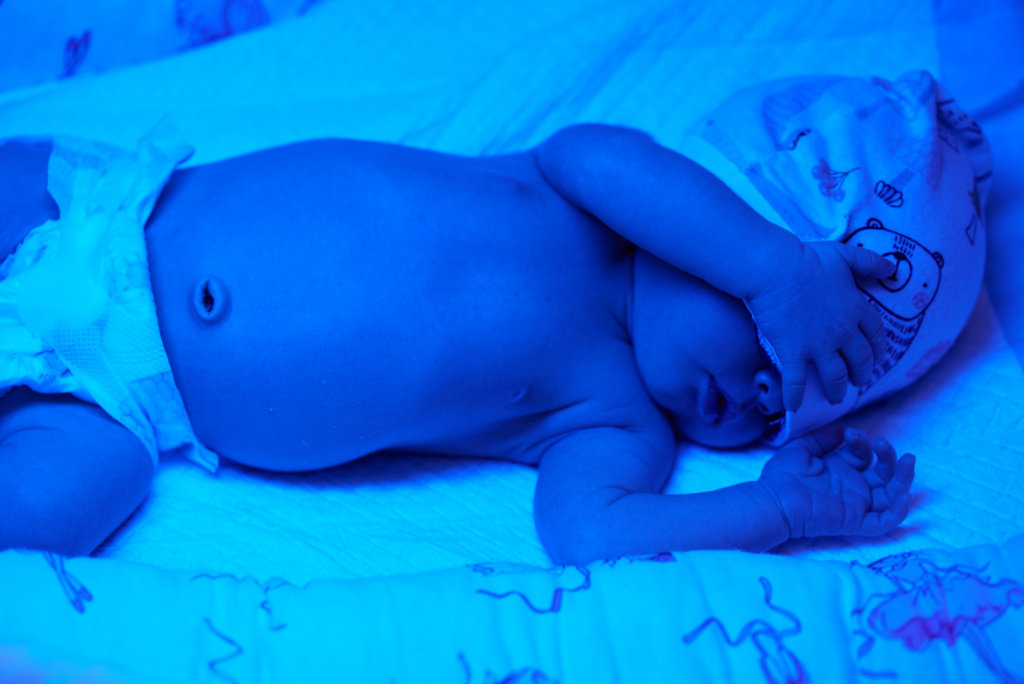 Newborn-baby-Phototherapy